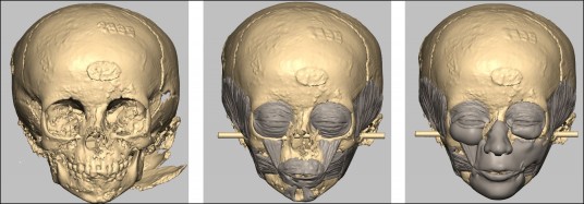 Steps in the facial reconstruction of a three-year-old boy from Ancient Egypt. (Source: Spurlock Museum) 